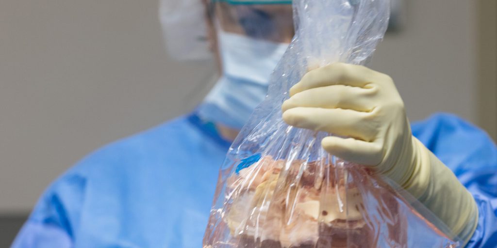 I “turisti del trapianto” ricevono organi più rapidamente, mentre gli americani rimangono in attesa