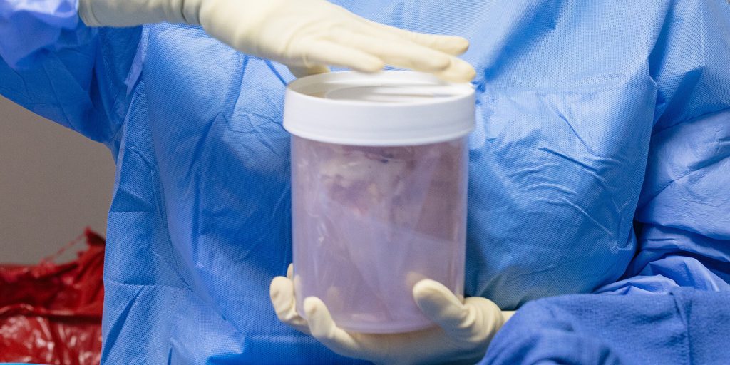 Controlli più severi riducono l’esclusione di pazienti dalle liste di attesa per trapianti d’organo