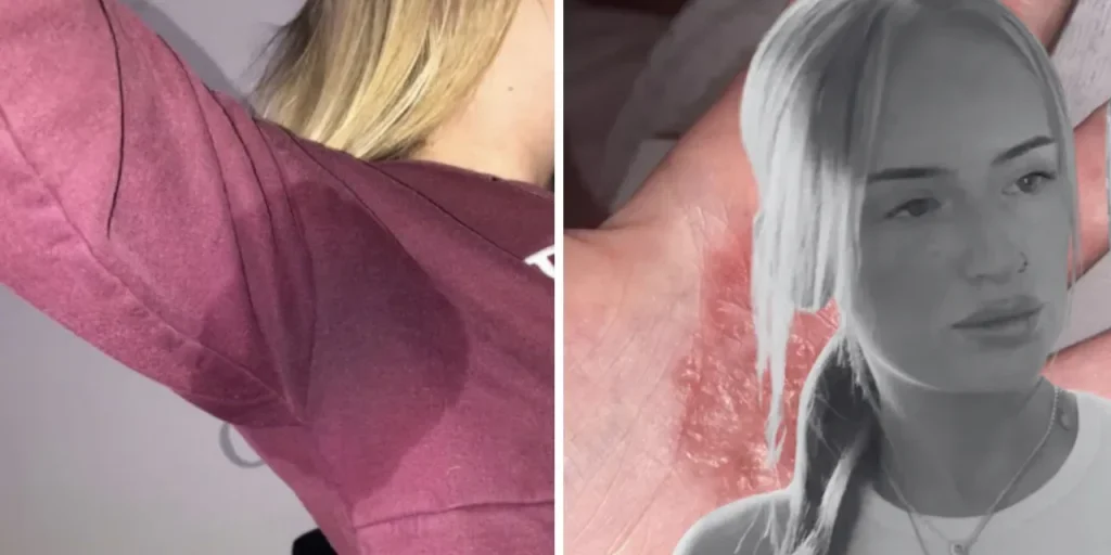 Darcie Hamilton, 22 anni, la lotta contro l'iperidrosi che ha portato all'abbandono della scuola