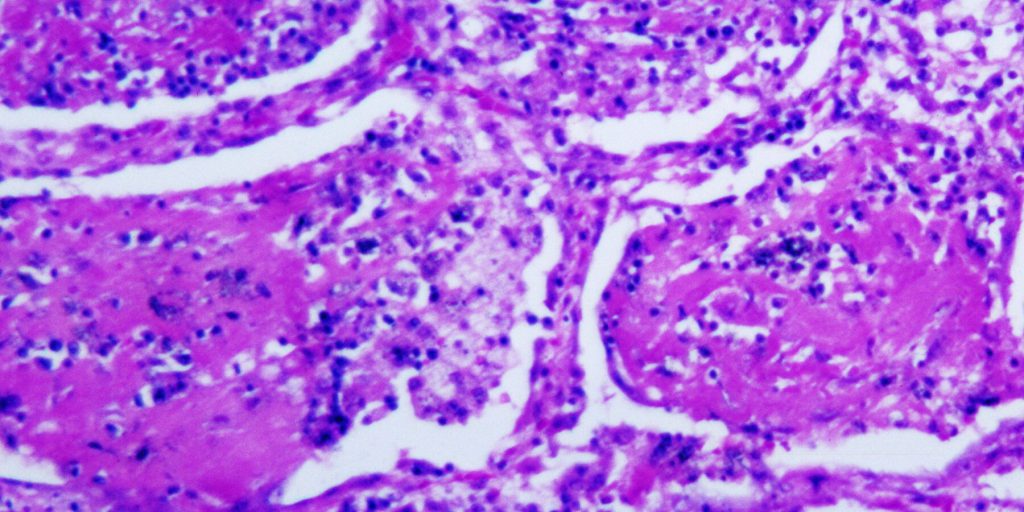 Decine di persone malate per un'infezione fungina rara in Tennessee