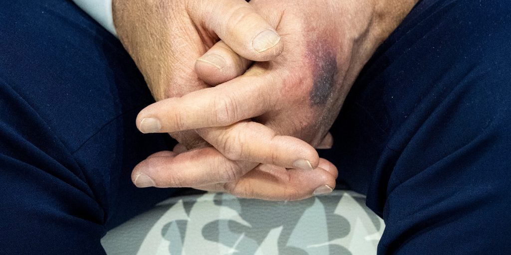 Trump: contusione sulla mano dopo colpo su tavolo, attribuisce l'uso di aspirina