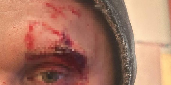 Direttore del Parco Forestale di Rjazan' Ferito con un'Ascia durante un Combattimento Medievale in Armatura