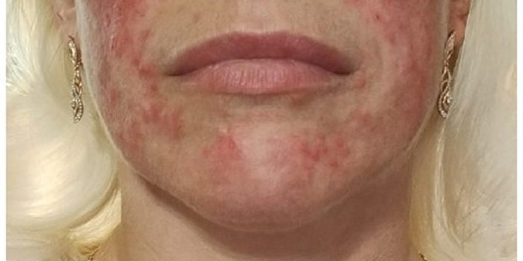 Опасность самолечения: случай стероидного дерматита у псковички напомнил о важности обращения к врачу