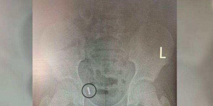 Воронежские врачи удалили у ребенка аппендикс вместе с проглоченными магнитами