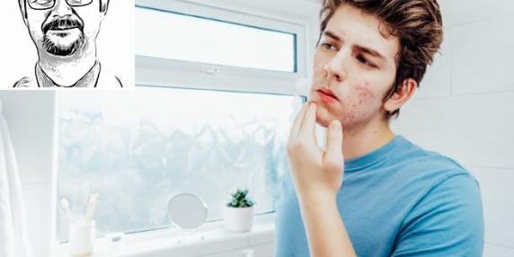 Trattamenti efficaci per l'acne severa negli adolescenti: antibiotici, ormoni e isotretinina