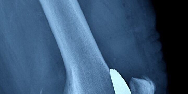 Операции по замене коленных суставов проводят и в Балахнинской ЦРБ