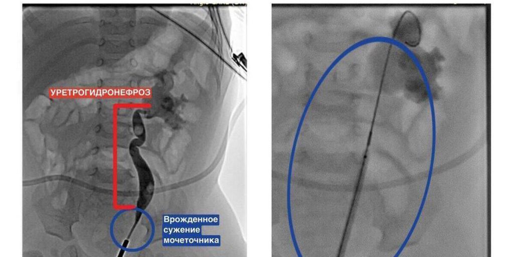 Врачи Центра Рошаля спасли почку 5-месячному ребенку с помощью уникальной технологии
