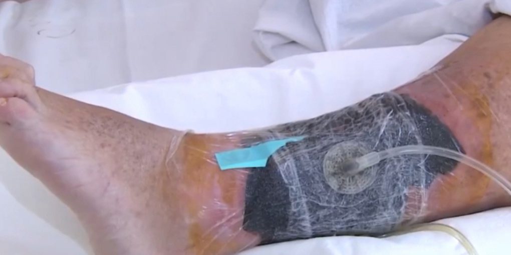 Ospedale di Orël: nuovo apparecchio per il trattamento di ferite complesse migliora la qualità dell'assistenza sanitaria