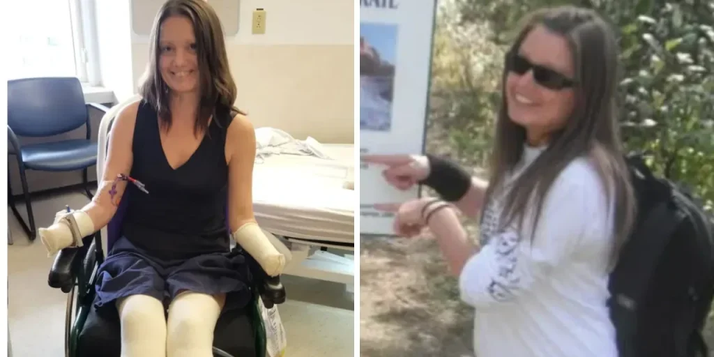 Shock tossico da streptococco di gruppo A porta a amputazioni di mani e piedi in Alberta