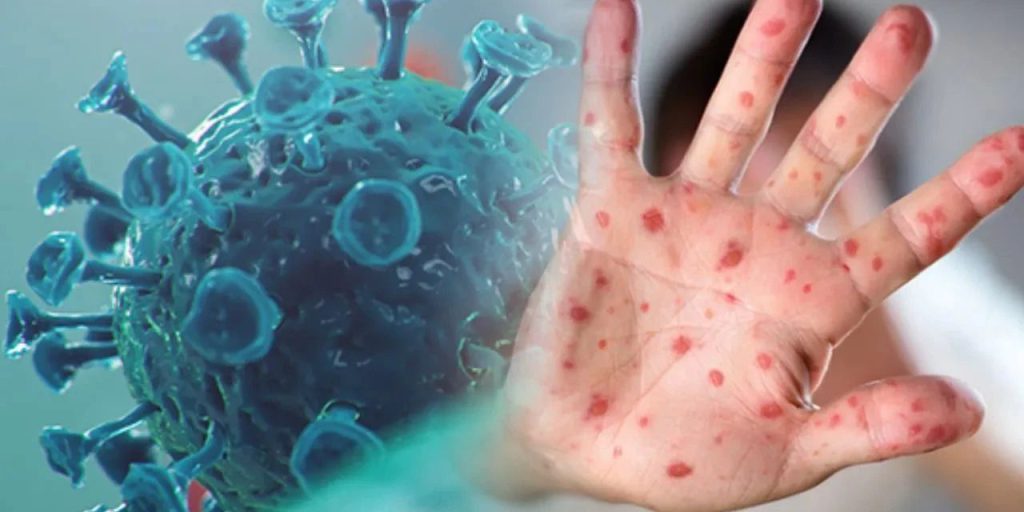 Nuova Variante del Vaiolo delle Scimmie: Una Minaccia Globale in Rapida Diffusione