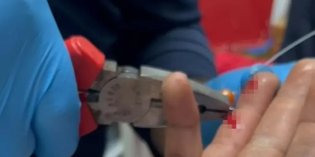 Incidente: ago infilato nella mano durante il pasto di pesce, rimosso con successo