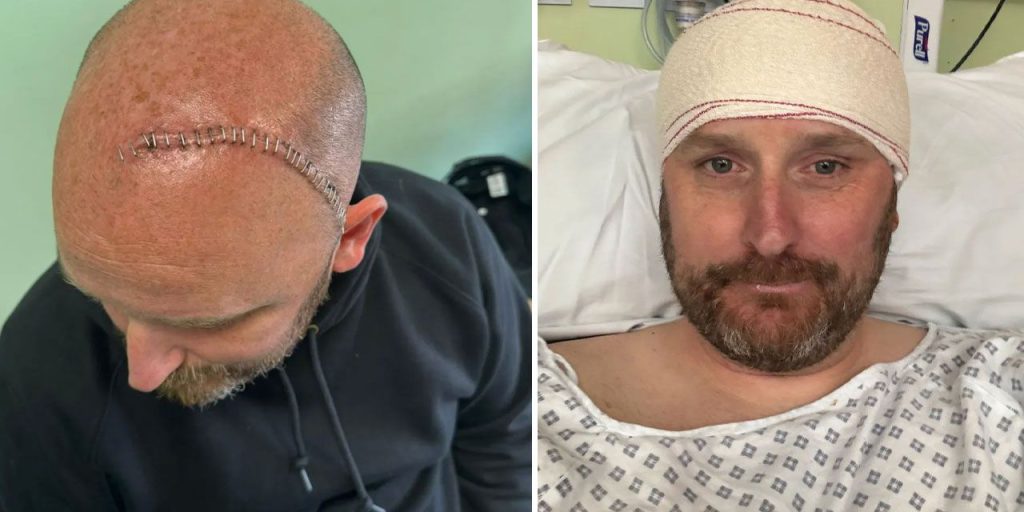 Diagnosi a sorpresa per un padre di 42 anni: solo 6 anni di vita dopo una visita in ospedale per vertigini

Approfondimento
La storia di Paul Whitaker, un pompiere di 42 anni residente a Cambridgeshire, in Inghilterra, è un esempio di come una visita in ospedale per un sintomo apparentemente banale possa portare a una diagnosi devastante. La vertigine e la stanchezza sono sintomi comuni che possono essere causati da diverse condizioni, ma in questo caso hanno portato a una scoperta più grave.

Possibili Conseguenze
La diagnosi di Paul Whitaker potrebbe avere conseguenze significative sulla sua vita e su quella della sua famiglia. La notizia di avere solo 6 anni di vita potrebbe essere difficile da accettare e potrebbe richiedere un adattamento significativo alle sue abitudini e priorità.

Opinione
È importante notare che ogni persona reagisce in modo diverso a una diagnosi del genere. Alcuni potrebbero sentirsi scoraggiati e perdere la speranza, mentre altri potrebbero trovare la forza di lottare e di cercare nuove opzioni di trattamento.

Analisi Critica dei Fatti
La storia di Paul Whitaker sottolinea l'importanza di non sottovalutare i sintomi e di cercare aiuto medico quando necessario. La diagnosi precoce e il trattamento possono fare una grande differenza nel corso di una malattia.

Relazioni con altri fatti
La storia di Paul Whitaker è un esempio di come la salute possa essere fragile e imprevedibile. È importante prendersi cura della propria salute e di quella dei propri cari, e di non sottovalutare i sintomi che potrebbero essere segni di una condizione più grave.

Contesto storico
La diagnosi di Paul Whitaker è un esempio di come la medicina possa essere imprevedibile e di come le condizioni di salute possano cambiare rapidamente. La storia della medicina è piena di esempi di persone che hanno ricevuto diagnosi devastanti e che hanno trovato il modo di superarle.

Fonti
La fonte di questo articolo è Haberler.com. L'articolo originale può essere trovato al link: https://www.haberler.com/bas-donmesiyle-hastaneye-giden-babaya-yikici-teshis-15625454-haberi/