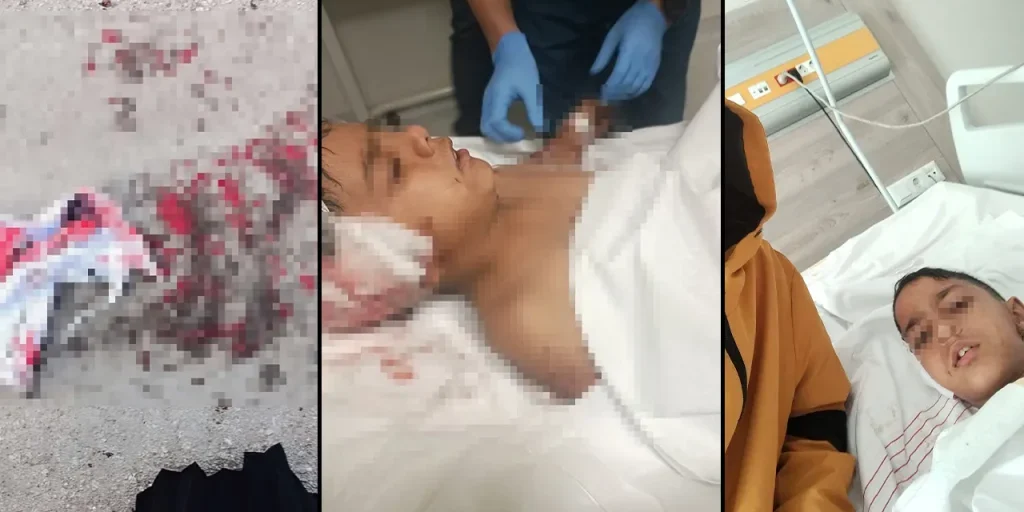 Bambino di 8 anni ferito da cane randagio a Ankara: soccorso rapido dei vicini