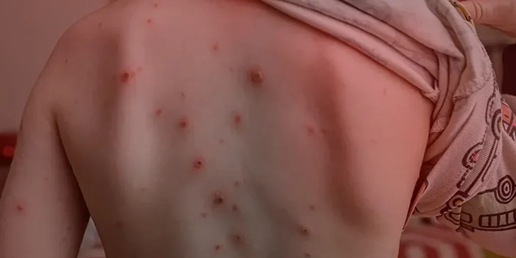 Scabbia torna nelle scuole: sintomi, diffusione e consigli degli esperti