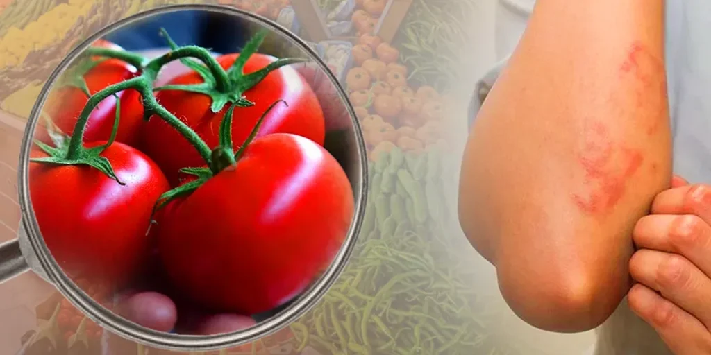 90 minuti di rischio: alimenti che possono causare orticaria nei bambini e nei giovani