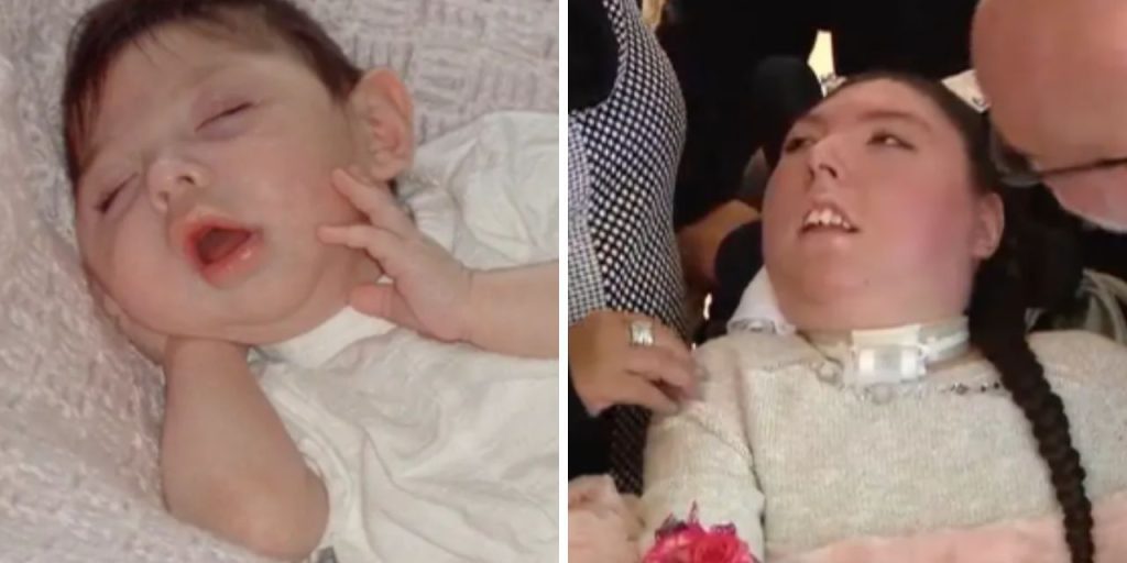 Un giovane contro tutte le previsioni: la storia di Alex Simpson, il ragazzo senza cervello che ha compiuto 20 anni