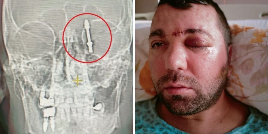 Beynine saplanan implant hayatını kabusa çevirdi! Diş hekimine verilen cezaya isyan etti