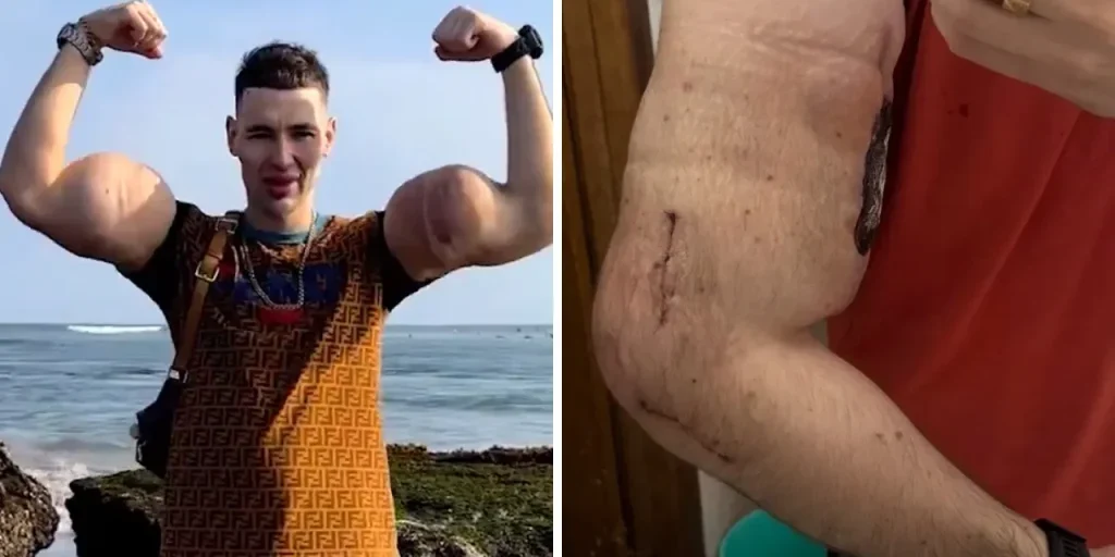 Kirill Tereshin rischia la perdita delle braccia a causa di infezione da iniezioni chimiche