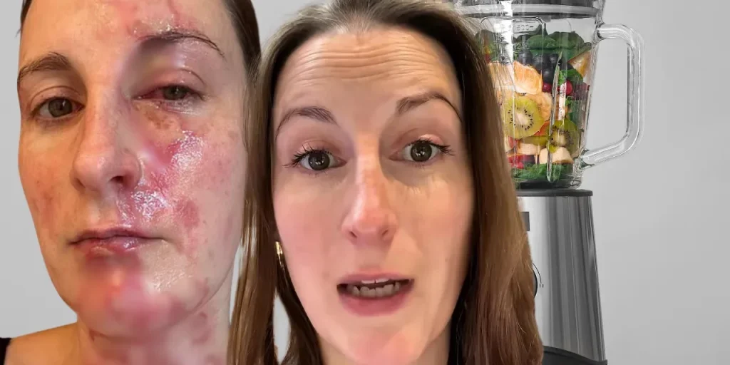 Incidente con frullatore: donna di 35 anni subisce gravi ustioni al viso e collo