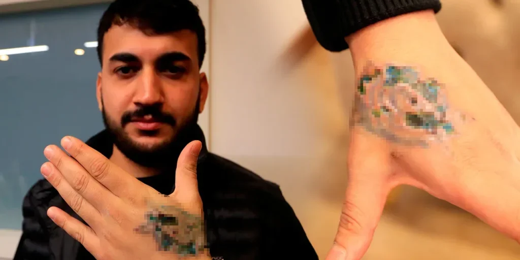 Yasin Taş denuncia centro di bellezza dopo seconda fiamma durante rimozione tatuaggio