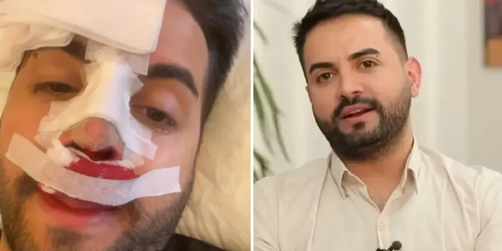 Kadir Ezildi pubblica foto con il naso avvolto: i follower preoccupati, la verità svelata