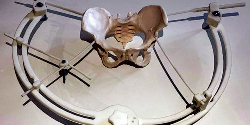 Patente concessa a dispositivo medico per fissare temporaneamente fratture complesse del bacino