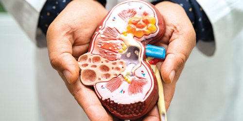 Rivoluzione nel trattamento delle calcolosi renali: tecnica innovativa basata sulla modifica genetica di batteri intestinali