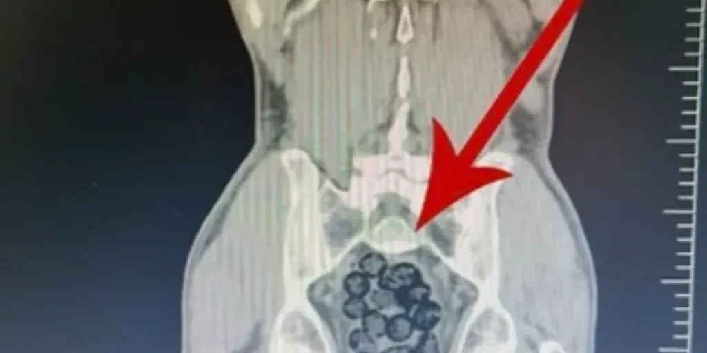 Arrestato passeggero a Batman con 64 pacchetti di droga nel corpo