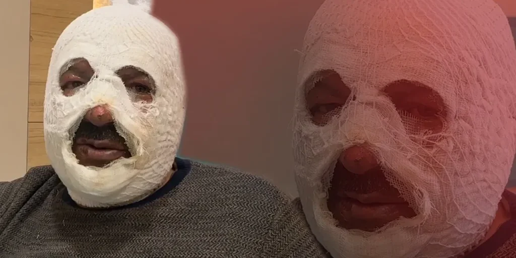 Incidente in miniera di Erzurum: Mehmet Sezen subisce ustioni mentre aiuta un collega