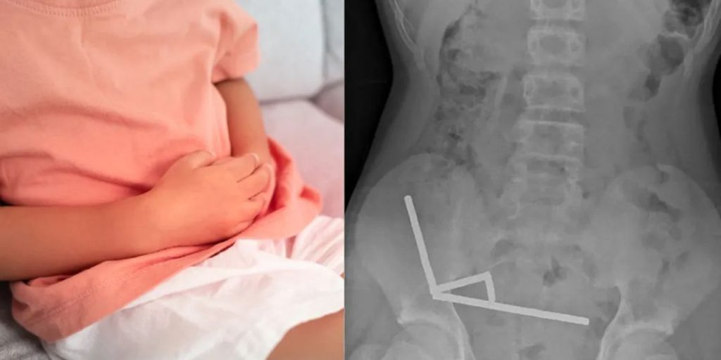 Oyun sanmıştı, kabusa döndü! 13 yaşındaki çocuk 200 mıknatıs yuttu