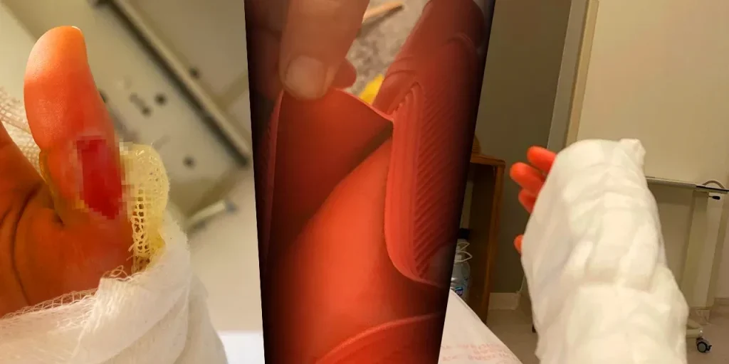 Borsa dell’acqua calda scoppiata: giovane donna ferita da ustioni al 25 % del corpo