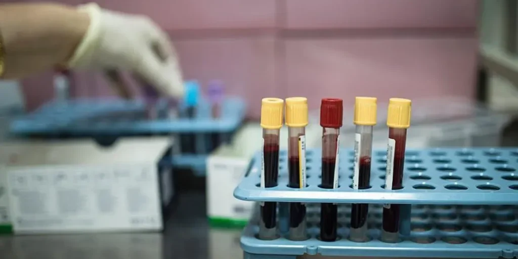 Cancro della vescica: riconoscere i segni del pericolo silenzioso