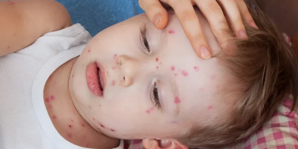 Aumento della diffusione del morbillo: rischio per bambini e adolescenti