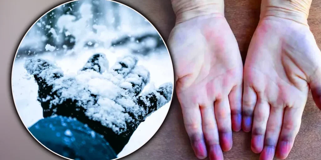 Fenomeno di Raynaud: cambiamenti di colore delle mani e dei piedi al freddo