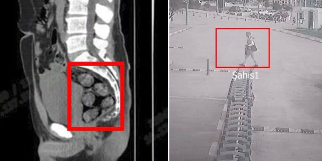 Tomografide şok eden görüntü! Midesinden çıkanların ardından hapsi boyladı