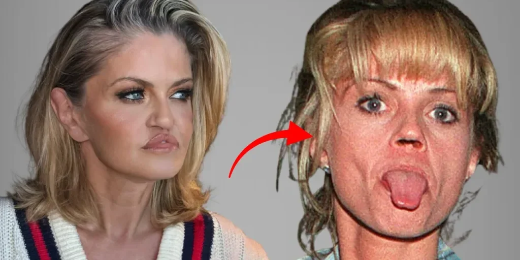 Danniella Westbrook: la dipendenza da droga ha causato danni al naso e alla bocca